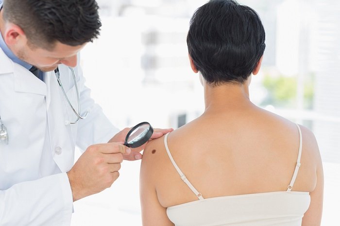 czerniak badanie skóry przez dermatologa